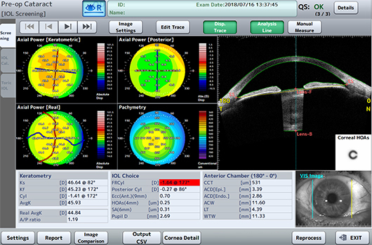 Tomografia do Segmento Anterior