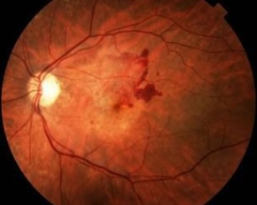 Degeneração Macular Relacionada à Idade