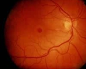 Buraco Macular