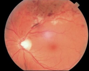 Obstruções Vasculares da Retina