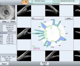 Tomografia do Segmento Anterior