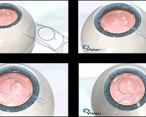 Implante de Lentes Fácicas para correção de Alta Miopia